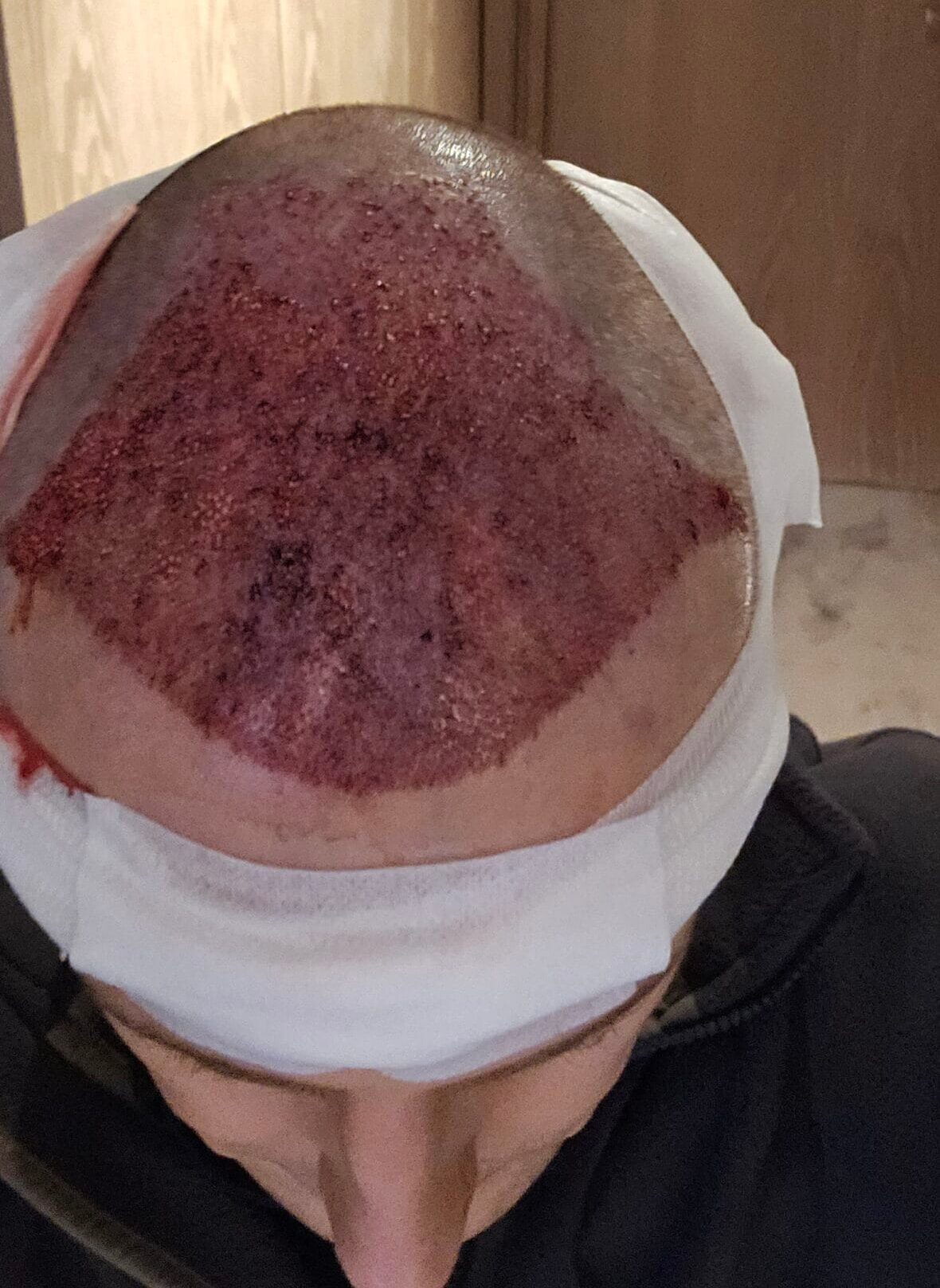Day of hair transplant procedure showing freshly implanted grafts