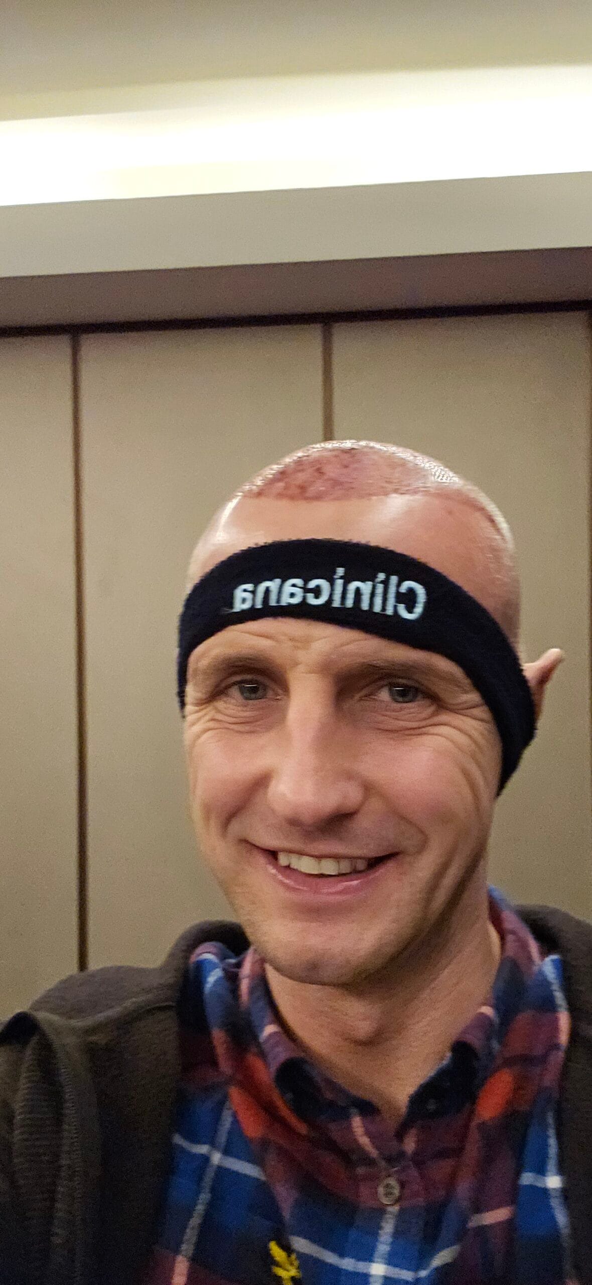 Hair transplant recipient area on Day 2 showing implanted grafts across new hairline