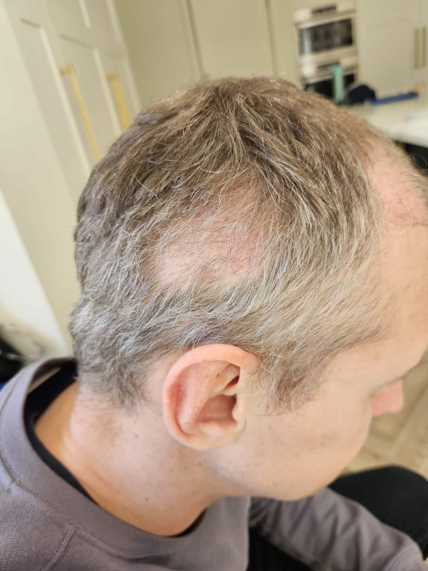 12 weeks after hair transplant