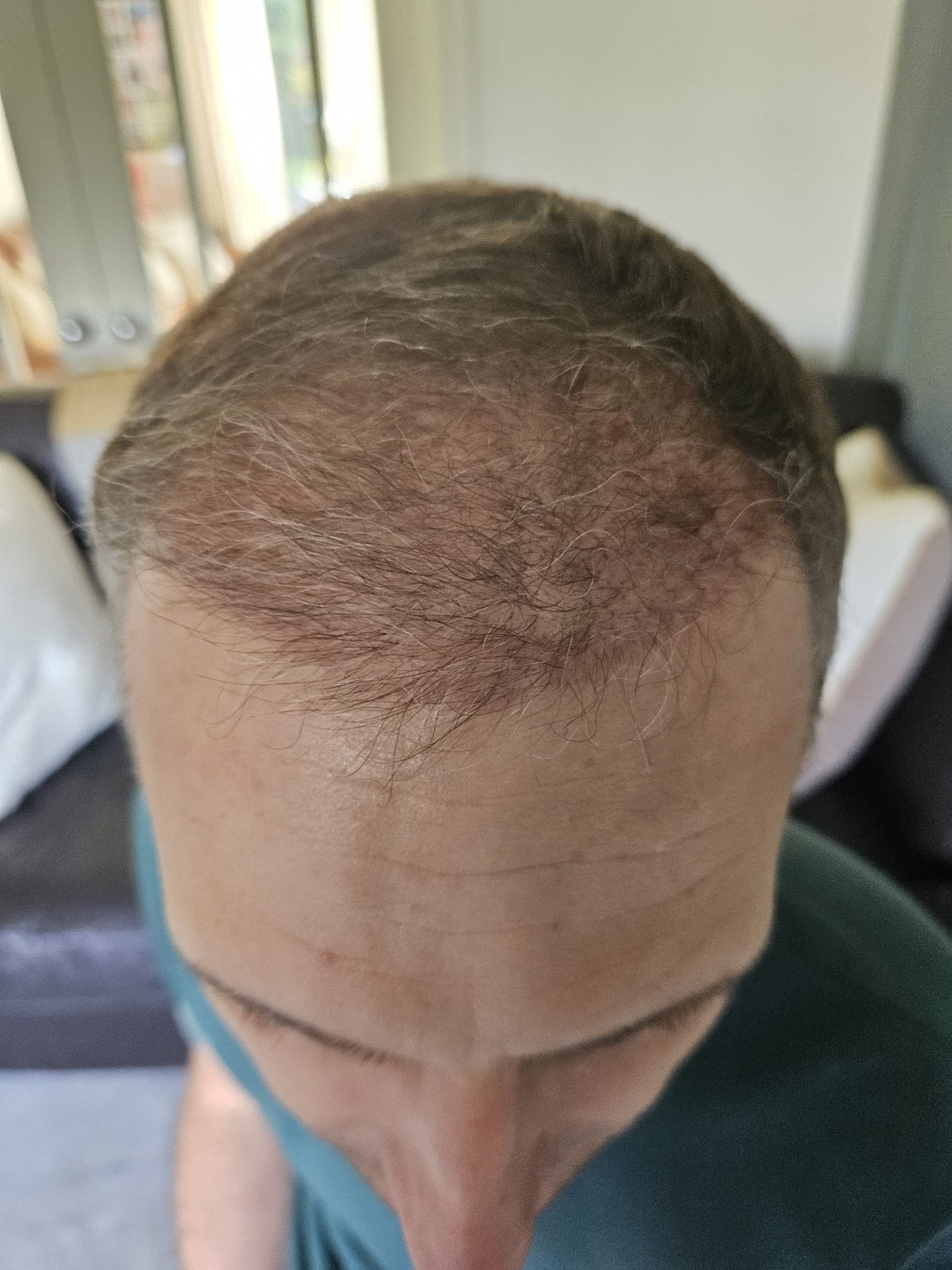 Scalp at 16 weeks post hair transplant showing early regrowth