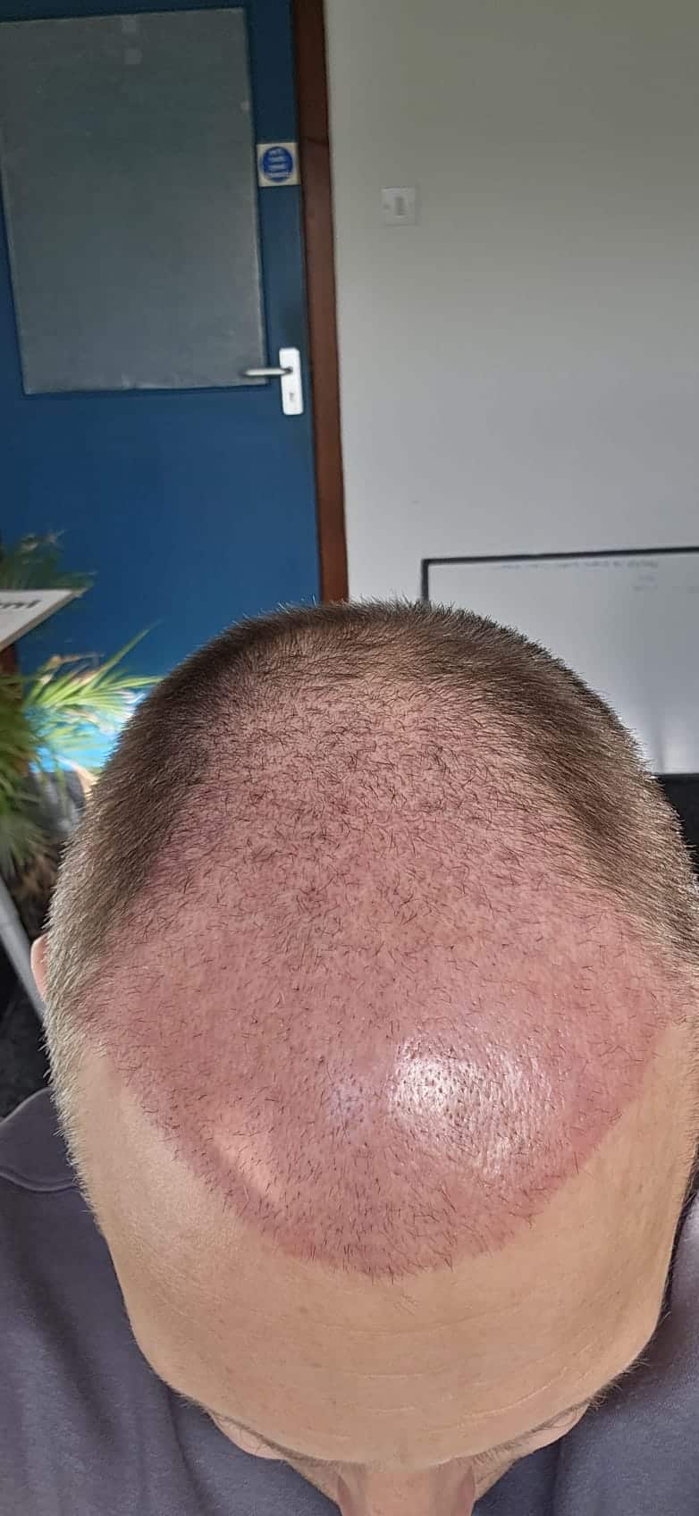 Scalp at 4 weeks post hair transplant showing redness and early shedding