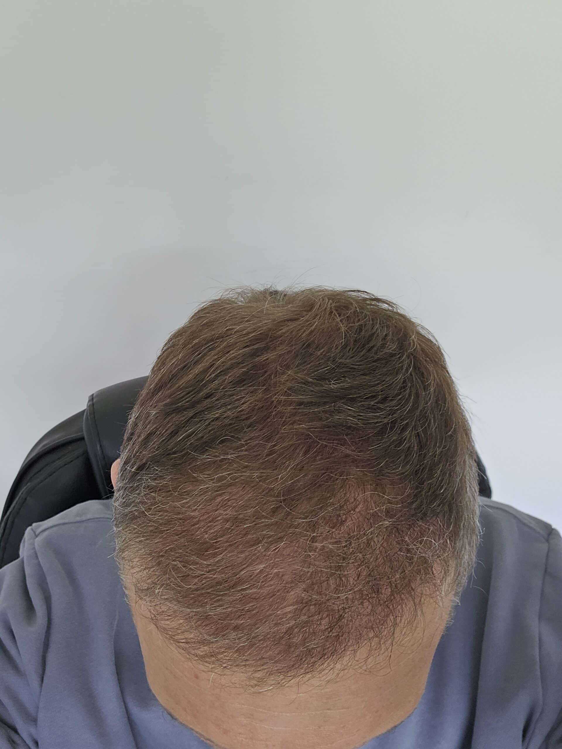 Hair transplant results at 5 months showing real coverage