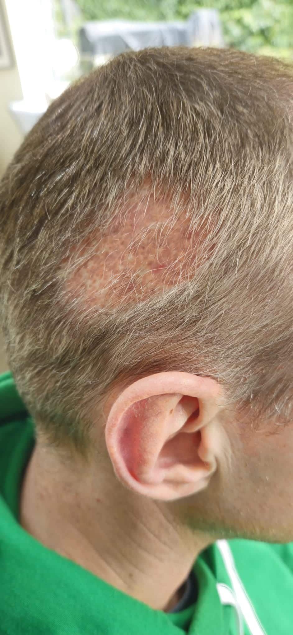 6 weeks after hair transplant — shedding phase