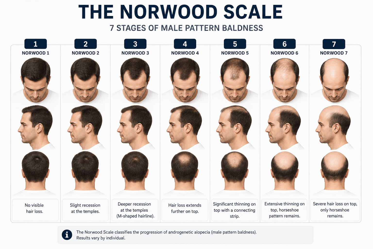 The Norwood Scale — illustrated diagram showing male pattern baldness stages 1 to 7, from top-down scalp view