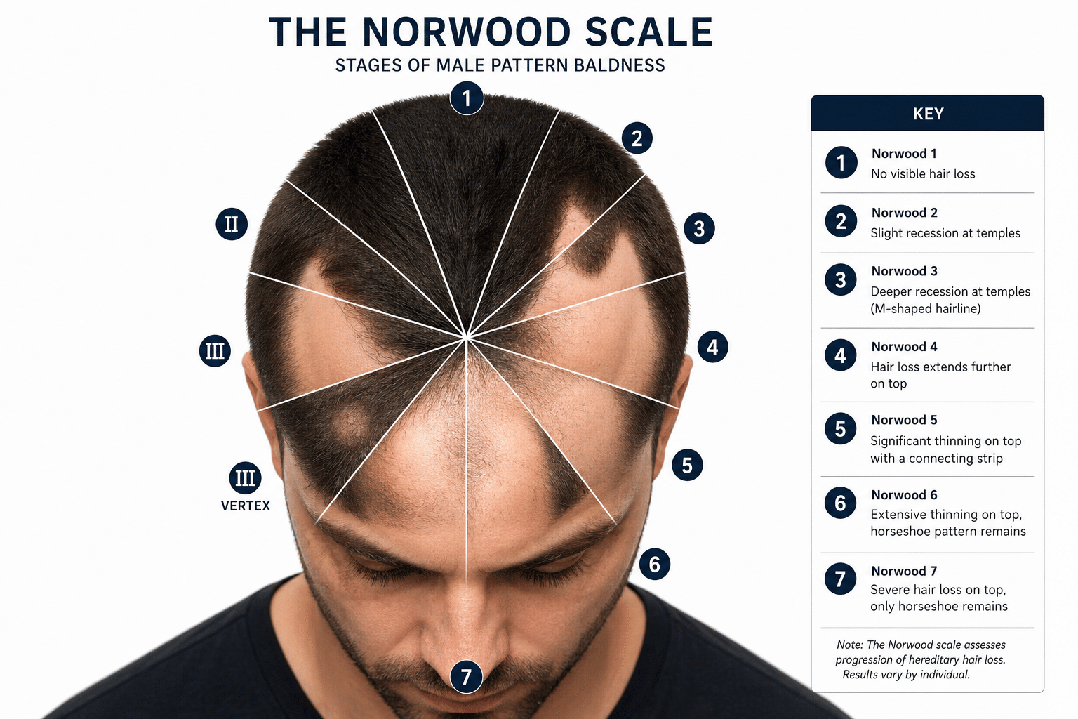 The Norwood scale explained