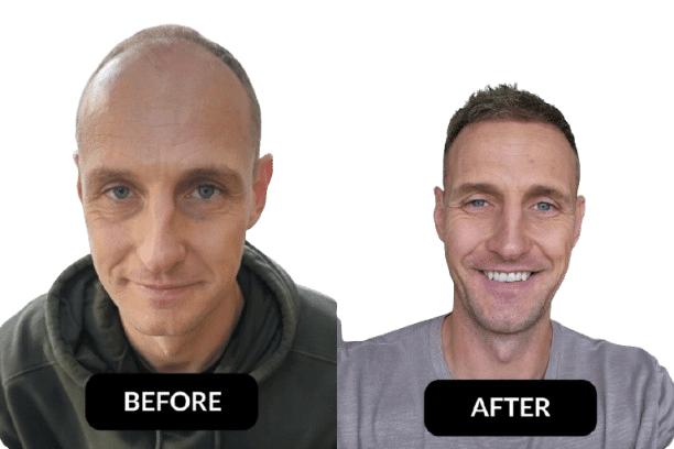 Jonathan's hair transplant before and after — bald before, full hairline after